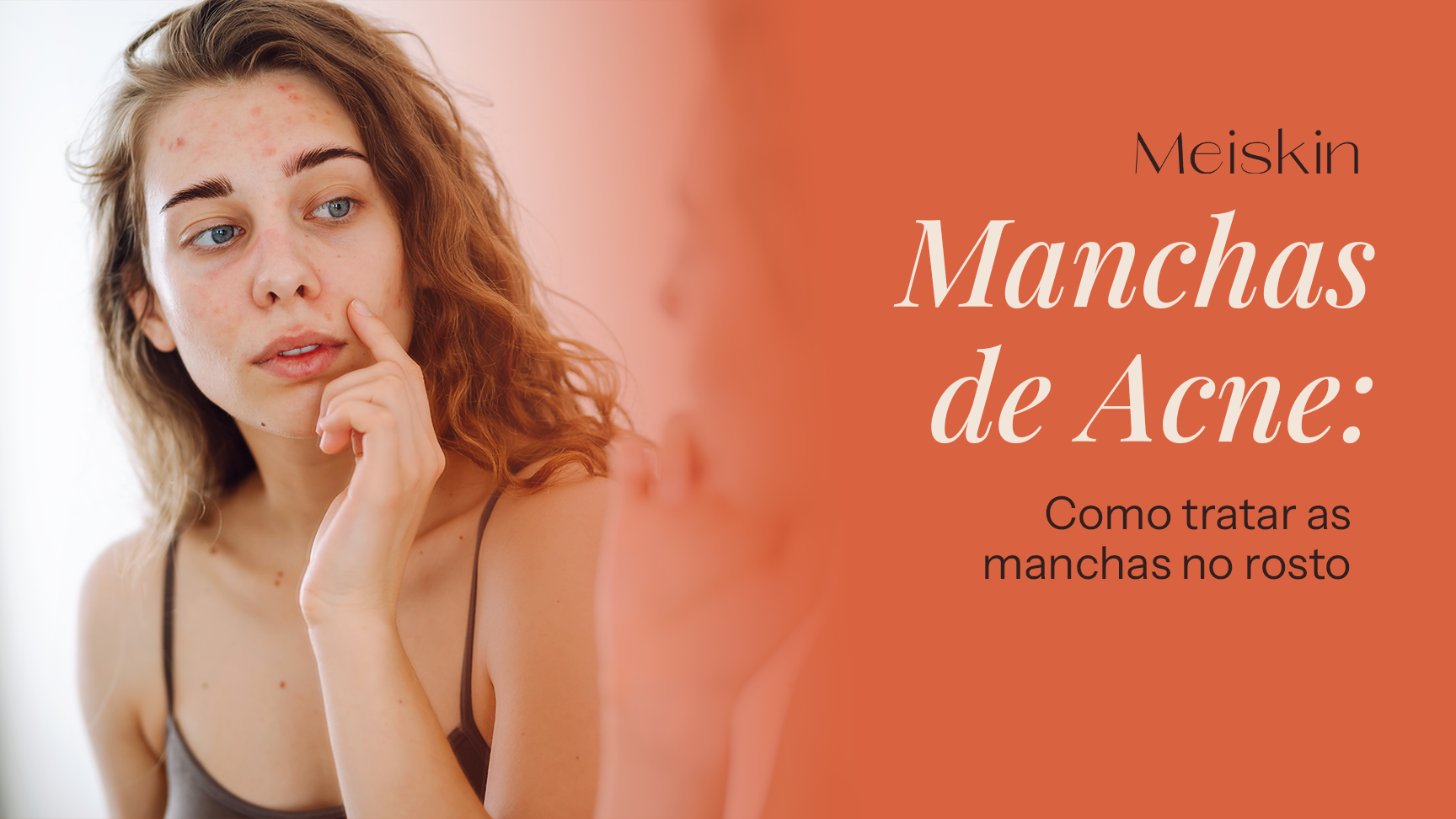 Manchas de Acne: Como Tratar as Manchas no Rosto
