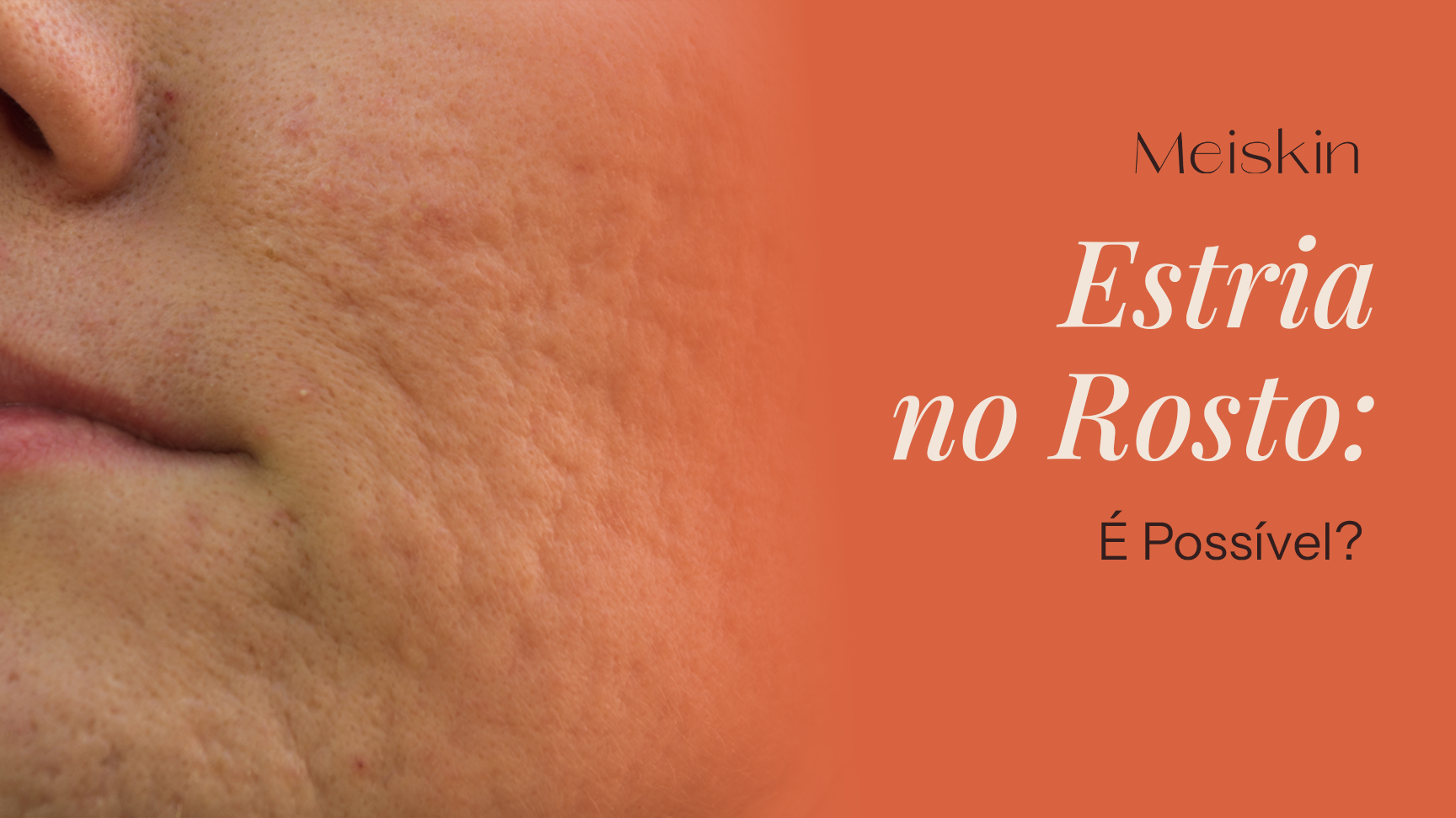 Estria no Rosto: É Possível?