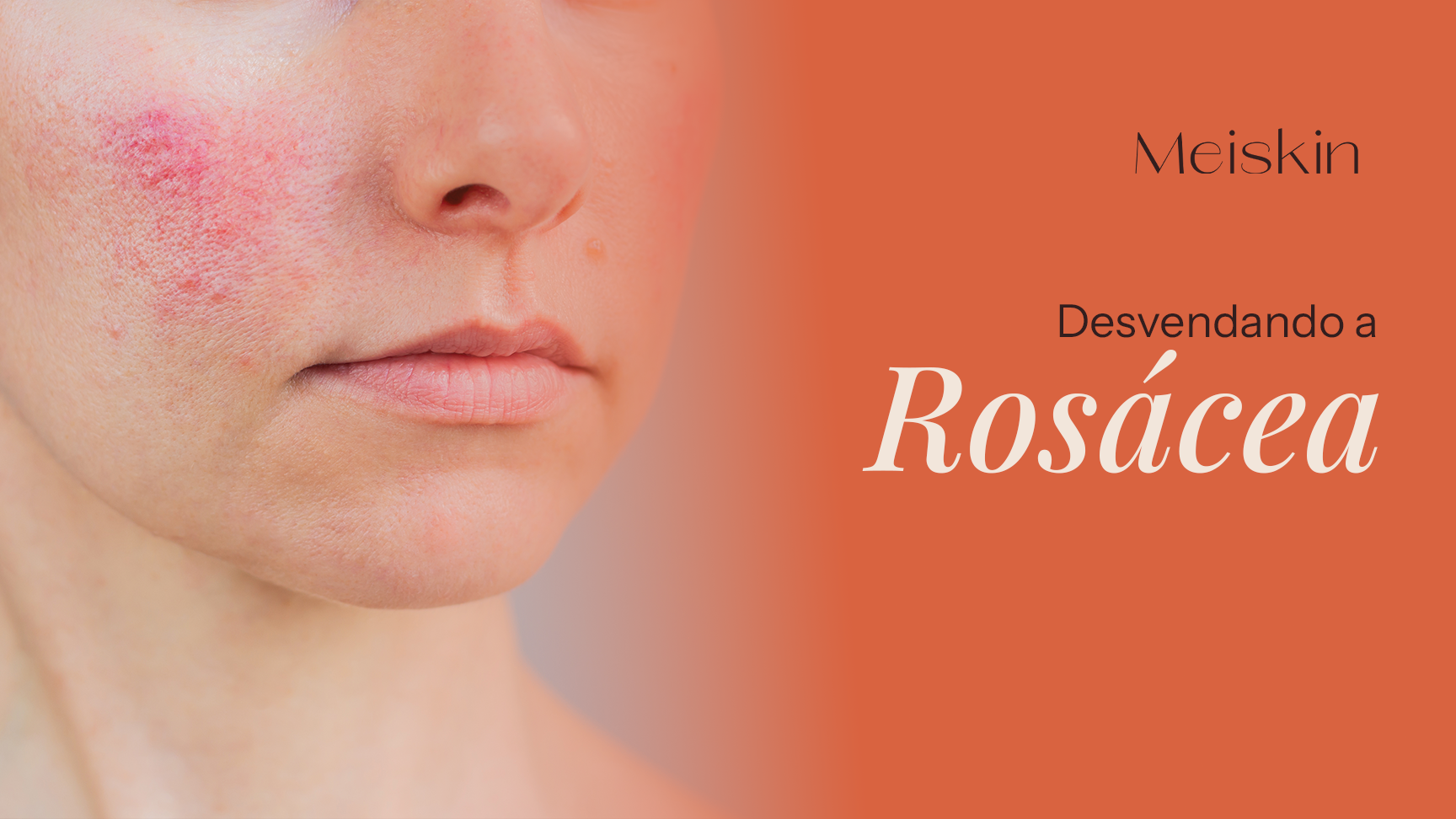 Desvendando a Rosácea